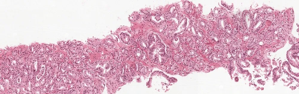 Central question during the challenge: Can you build a system to predict the grade group for this biopsy?