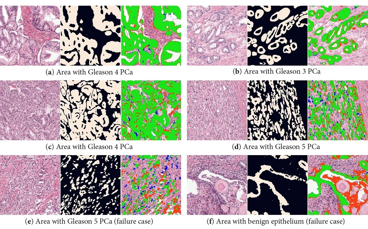 Segmentation examples from the test set. Green pixels show true positive, red false positive and blue false negative. The top two rows displays two cases (a–d) of PCa where the network segments the epithelial tissue almost perfectly. In the bottom row two failure cases are shown: a case of high grade PCa (e) and a benign region (f) where debris inside the gland is segmented.
