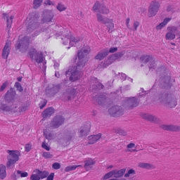 A single patch from a prostate biopsy slide.
