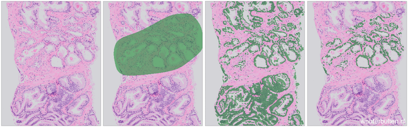 Example prostate tissue with PCa (extracted from a core needle biopsy) (1), tumor annotations (2), epithelium segmentation (3), segmentation and annotations combined (4).